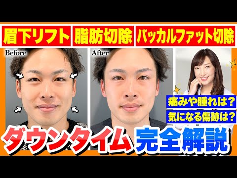 ダウンタイム完全解説！！【 眉下リフト ＋ 脂肪切除 ＋ バッカルファット切除 】