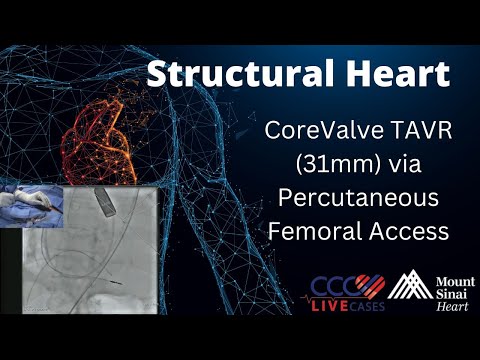 CoreValve TAVR (31mm) via Percutaneous Femoral Access - June 2015 Structural Live Case