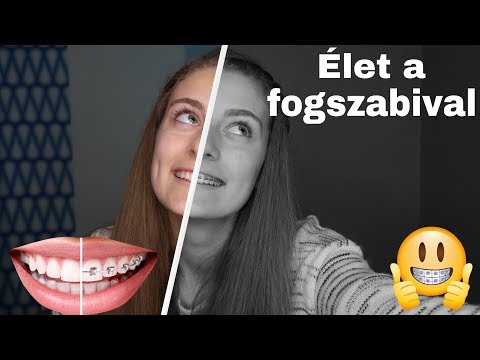 Fogszabályozóval lehet fogyni - Mit együnk, ha fogszabályzónk van?