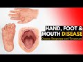 Hand, Foot, and Mouth Disease, Causes, Signs and Symptoms, Diagnosis and Treatment,