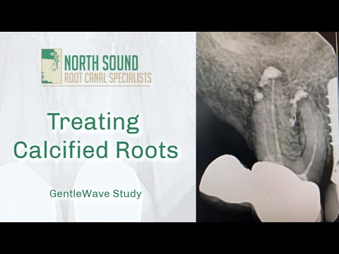 Root Canal Treatment on a Calcified Tooth- GentleWave®