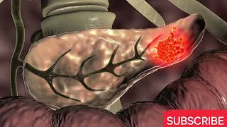 Why Pancreatic Cancer is So Deadly