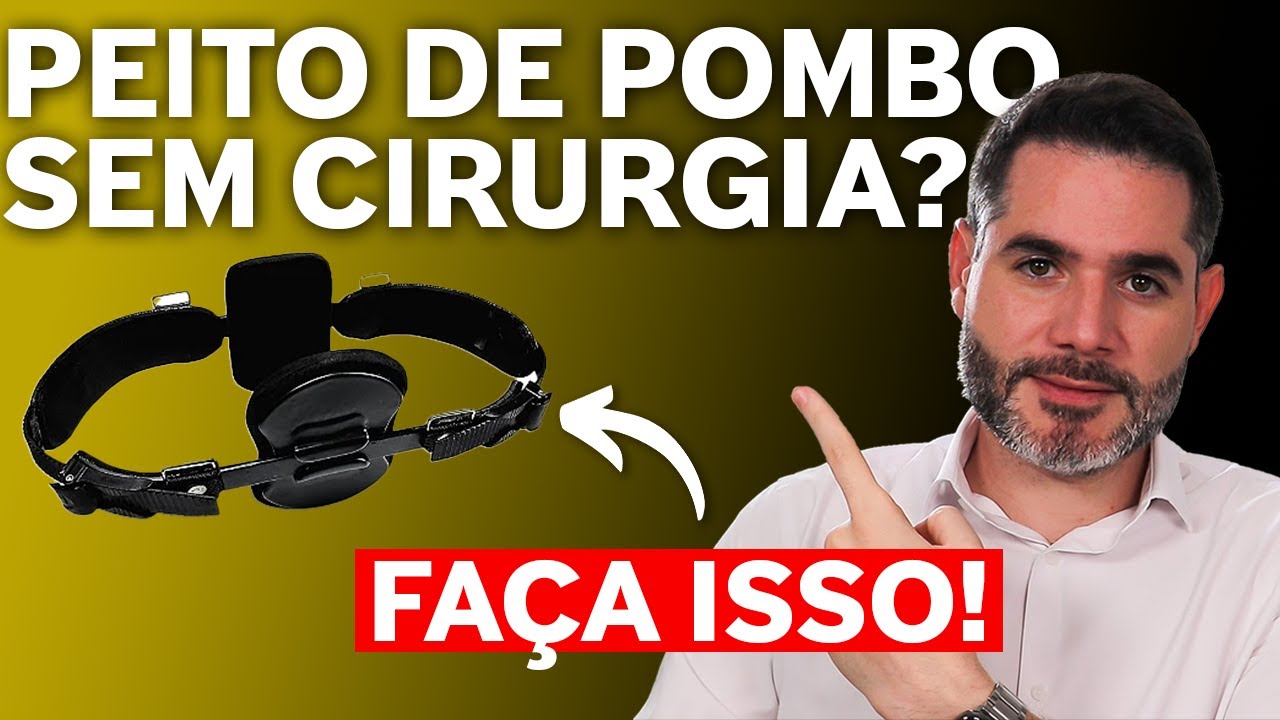 PEITO DE POMBO (Pectus Carinatum) SEM CIRURGIA? Quanto tempo é o tratamento?