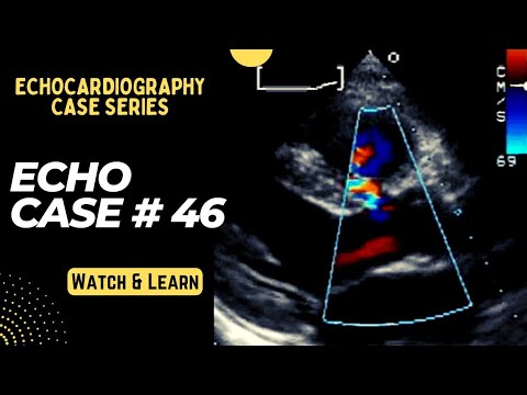 Echo Case 46: Echocardiography Spot Diagnosis Series - Cardiology