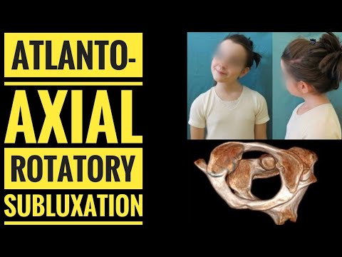 Grisel's Syndrome (Atlanto-Axial Rotatory Subluxation)