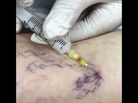 Sclerotherapy 2
