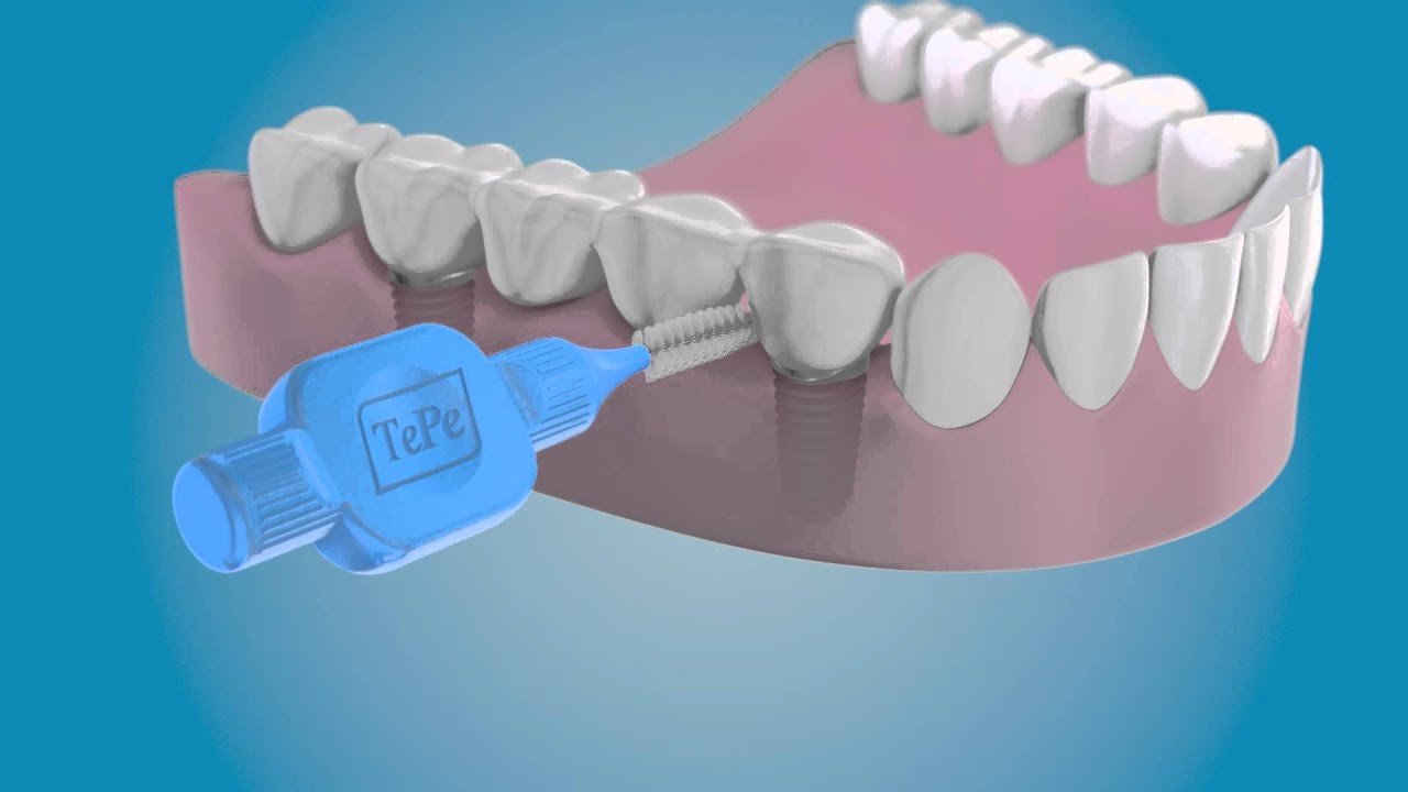 Dental implants Care How to clean