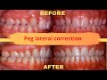 Peg lateral treatment : faster and easier technique