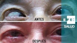 El estrabismo tiene doble solución oftalmológica