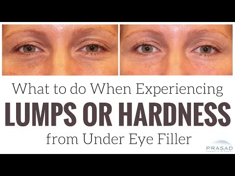 What to do When Experiencing Lumps or Hardness from Under Eye Filler