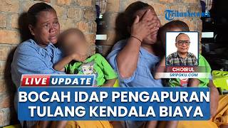 Kisah Restu Bocah 4,5 Tahun di OKU Timur, Derita Pengapuran Tulang Terkendala Biaya Pengobatan