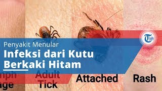 Penyakit Lyme Desease - Penyakit Menular dari Kutu