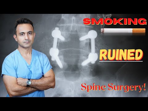 Failed spinal fusion