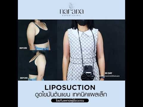โชว์แขนอย่างมั่นใจ แบบไม่ต้องปกปิด ด้วยการดูดไขมันแขน Lipolock-Liposuction ที่ นารดาคลินิก