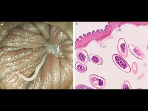 okozhat-e a hpv vírus petefészekrákot papillon zeugma relaxury 5 deluxe belek ileribasi)