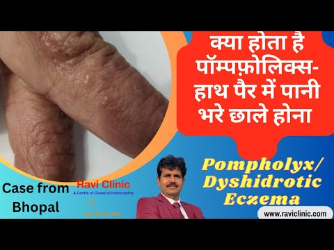 What is pompholyx or Dyshidrotic Eczema Real Time cured case study