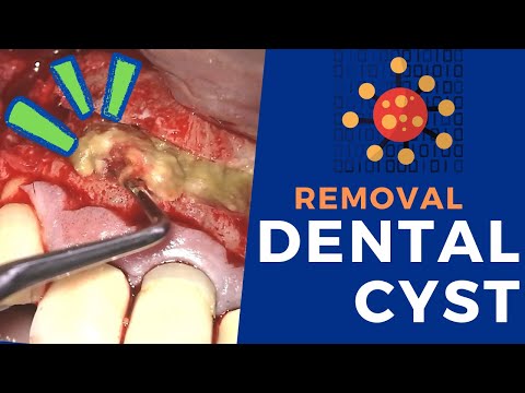 DENTAL CYST Removal – How is it done?