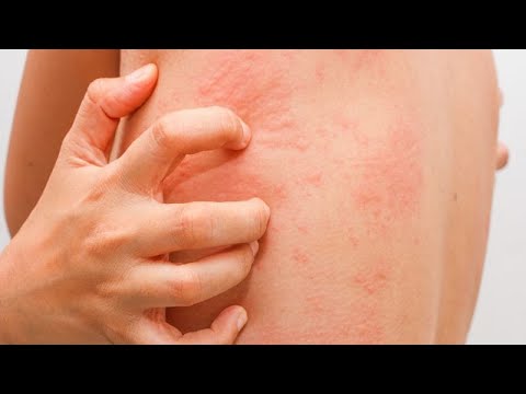 This disorder "pretends" to be other diseases - histamine intolerance