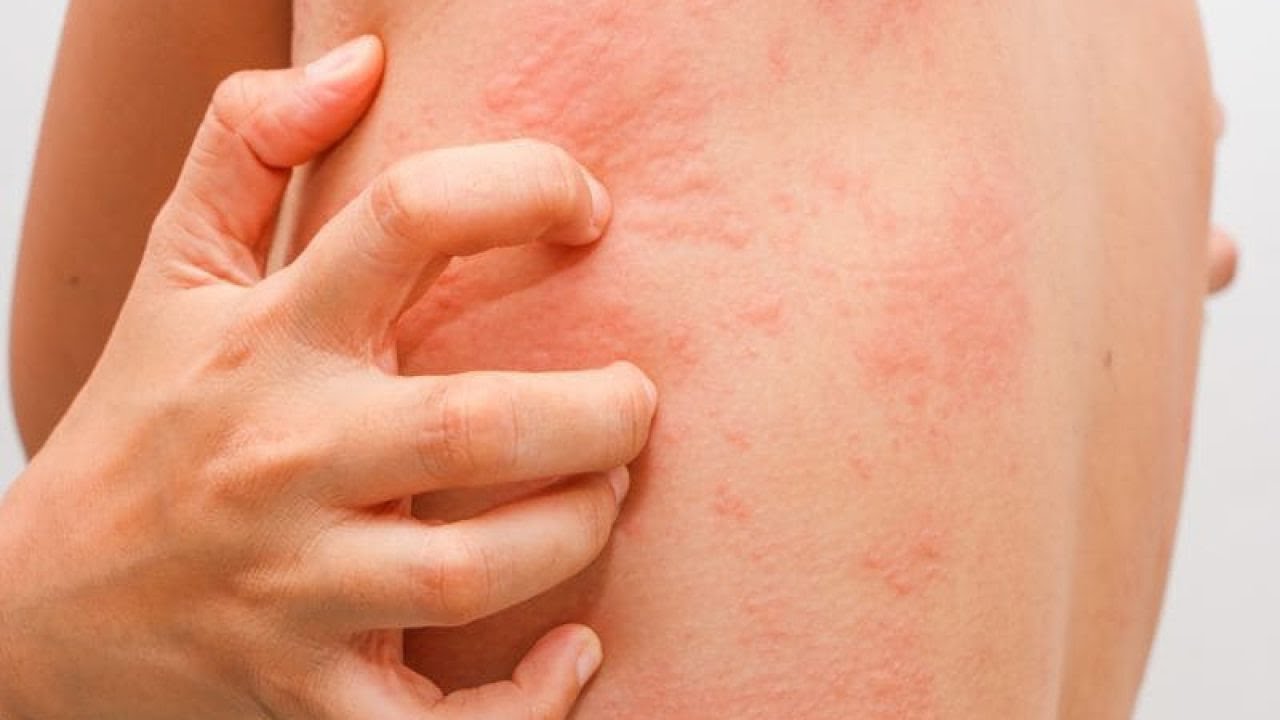 To zaburzenie "udaje" inne choroby - nietolerancja histaminy