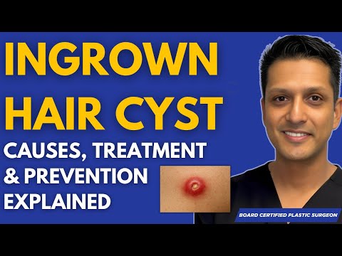 Ingrown Hair Cyst Explained: Causes, Treatment & Prevention