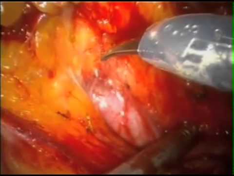 Robotic Ureterolithotomy with Flexible Pyeloscopy for Stone Clearance