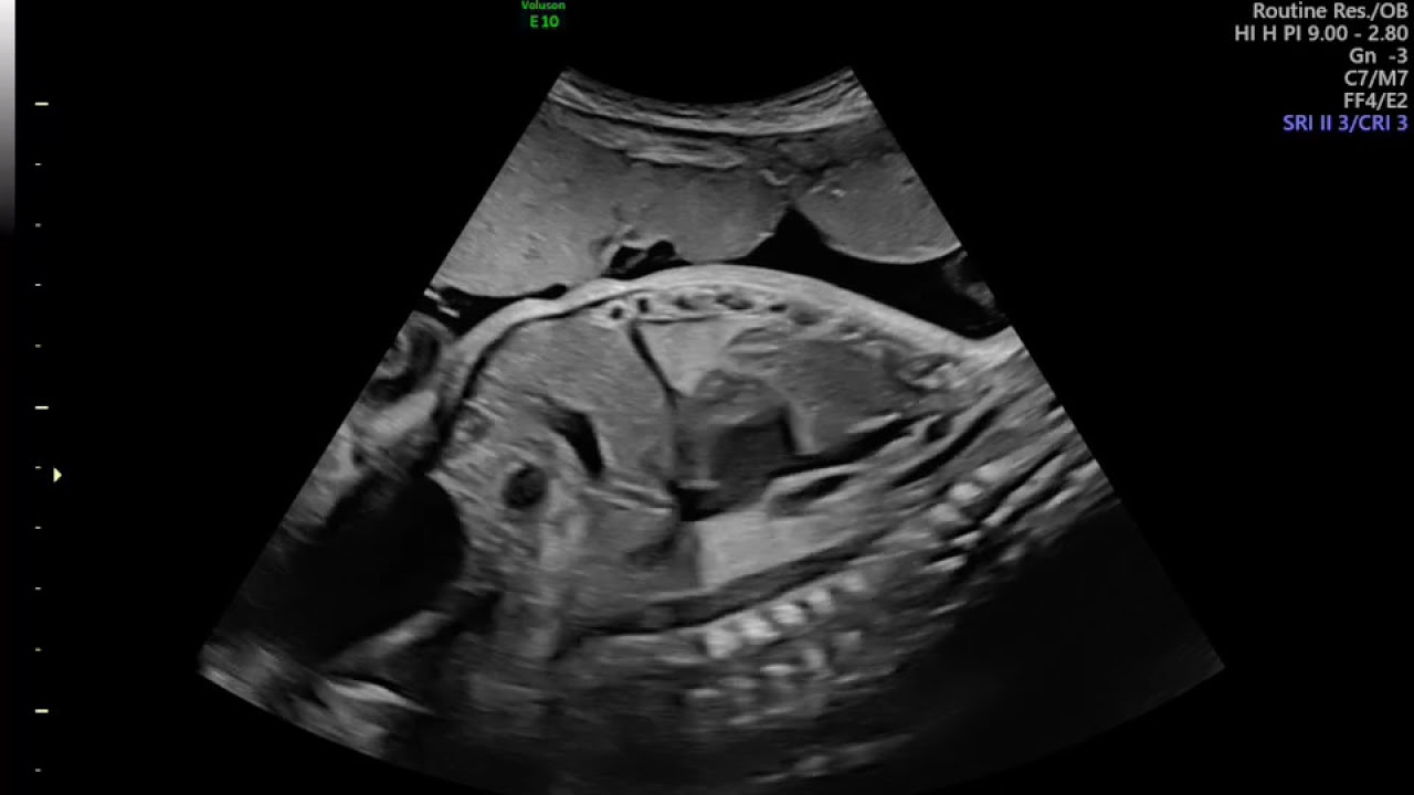CORAÇÃO FETAL
