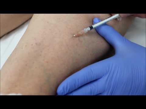 Injectarea în venă din varicoză