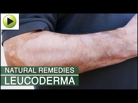 Leucoderma Natural Home Remedies Pespro Leucoderma Natural Home Remedies Pespro