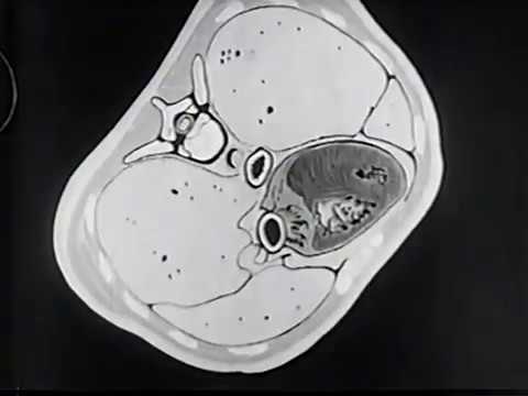 Carcinoma of the Esophagus (Assn of American Medical Colleges, 1953)