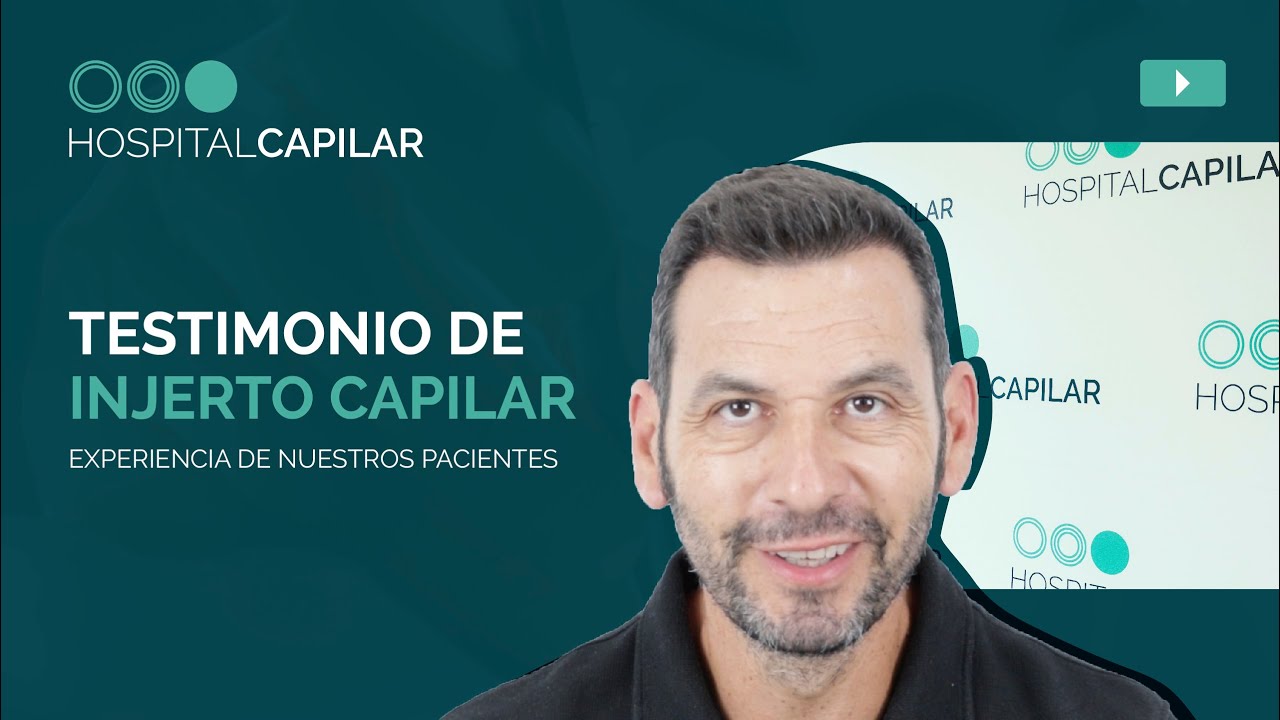 👀Testimony after a HAIR GRAFTING📣 | 👱🏼‍♂️Our patient's experience at SIX MONTHS💯