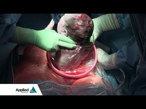 Cesarean Section featuring the Alexis® O C-Section Retractor