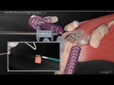 FiberTak™ DR Anchor Bridge Technique