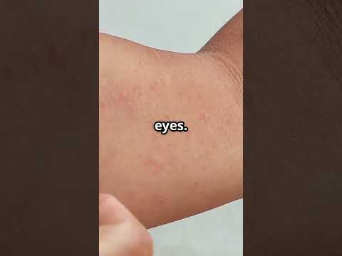 COVID-19 Symptoms 2025: What You Need to Know! #covid19  #covid19news  #covid19updates