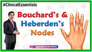 Bouchard’s and Heberden’s nodes : Clinical essentials