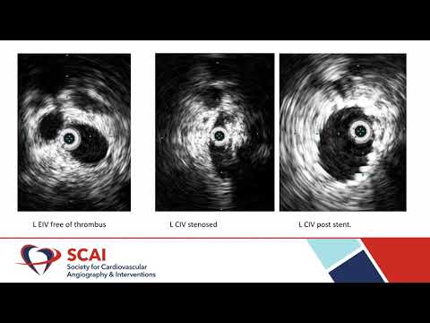 Iliocaval Venous Thrombosis in a Patient with IVC Filter