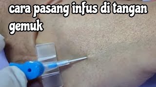 Download lagu How to insert an IV drip for a patient with fat hands. Large veins require a small Abocat. mp3 Download lagu How to insert an IV drip for a patient with fat hands. Large veins require a small Abocat. mp3