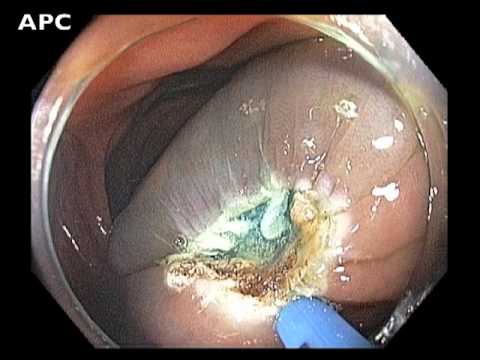 Ascending Colon - Management of Flat Lesion