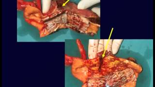 Dr Raffi Qasabian: The thoracic aorta in the endovascular era