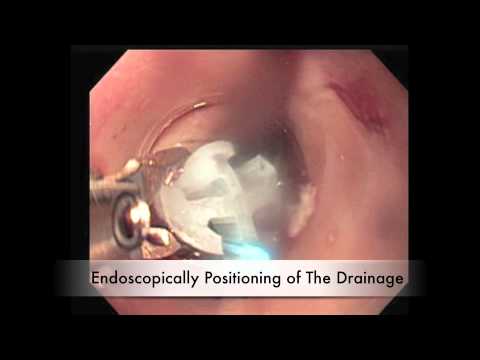Contemporary Flexible Endoscopic Management of Acute Esophageal Perforations