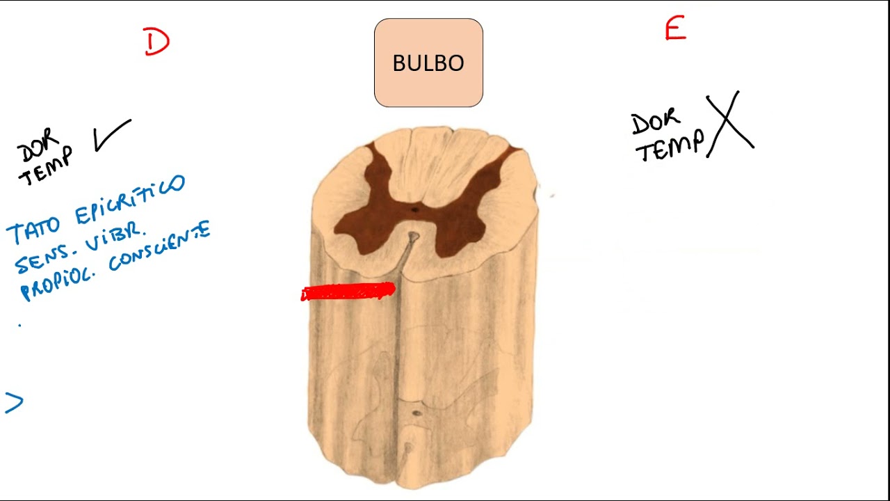 Lesão em medula e consequências na sensibilidade