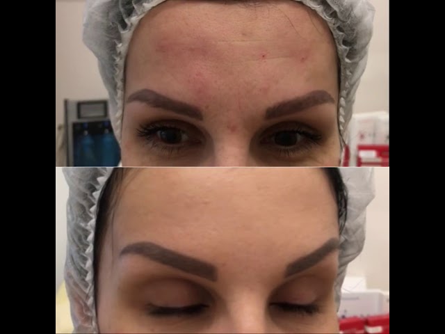 Коррекция морщин ботоксом