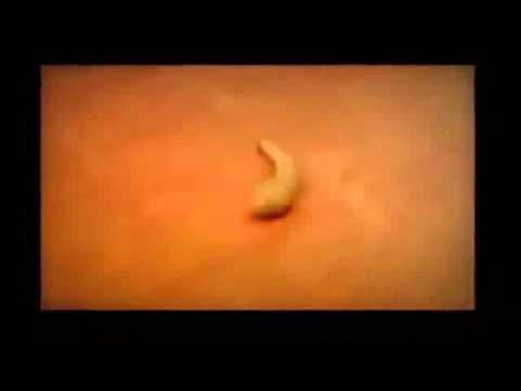 Popping zits compilation kopia