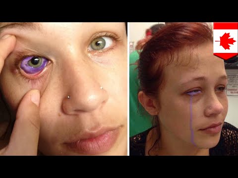 Eyeball tattoo: Model might get eye removed after eyeball tattoo goes horribly wrong - TomoNews