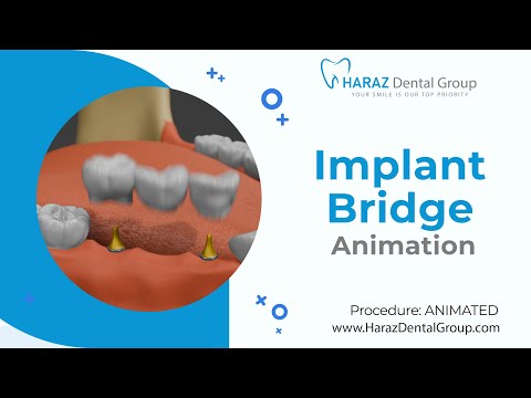 Implant for Denture