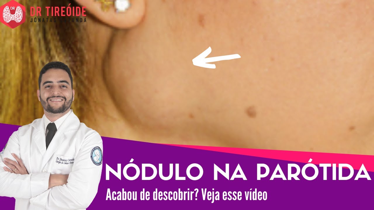 Nódulo na parótida - Vídeo para quem acabou de descobrir! | Dr Jônatas Catunda