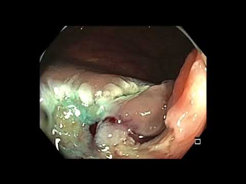 Extirpación de un pólipo de colon ascendente
