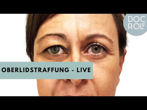 OBERLIDSTRAFFUNG ist MEHR als NUR Haut entfernen. Live aus dem OP - Doc.Rolf