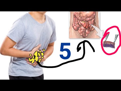 Bog xanuun iyo dibiryo ma dareentaa ma isku aragtay 5-taan calaamad ??