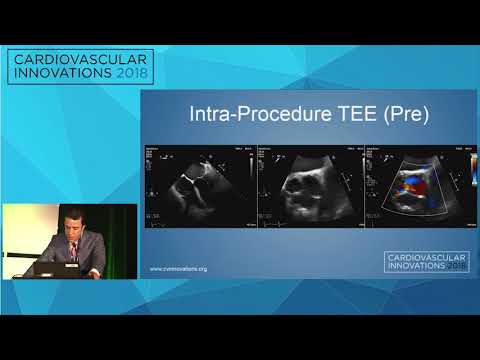 CVI2018 Session: The Boundaries of Structural Heart Therapy - I (Mt. Sopris, July 27, 08:30 am)