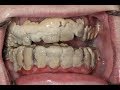 20 Years Without Brushing Teeth 😦 | Calculus Removal